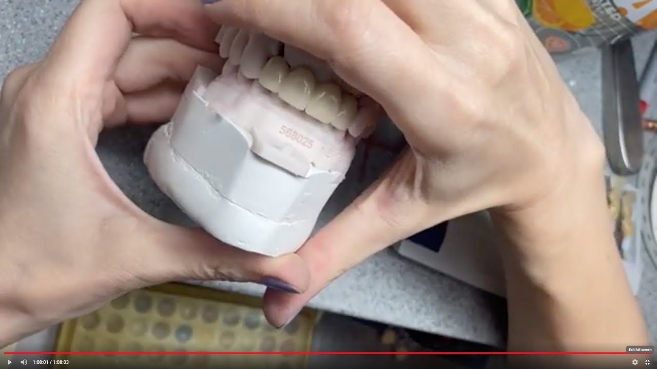 Anterior PFM Bridge Buildup - Start to Finish
