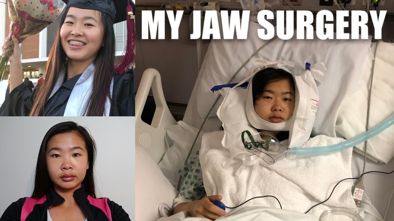 MY JAW SURGERY EXPERIENCE | LeFort I Osteotomy Day 1-35 of Recovery & Tips (VLOG 11) | katyyho