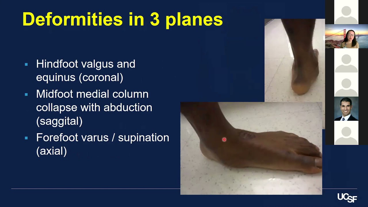 Adult Acquired Flatfoot - Dr. Chen