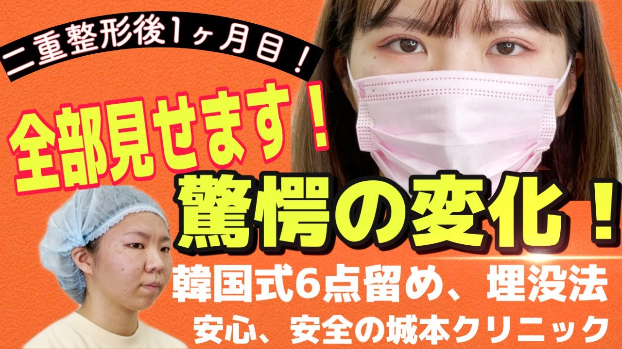 全部見せます！二重整形で驚愕の変化！埋没法（韓国式６点留め）