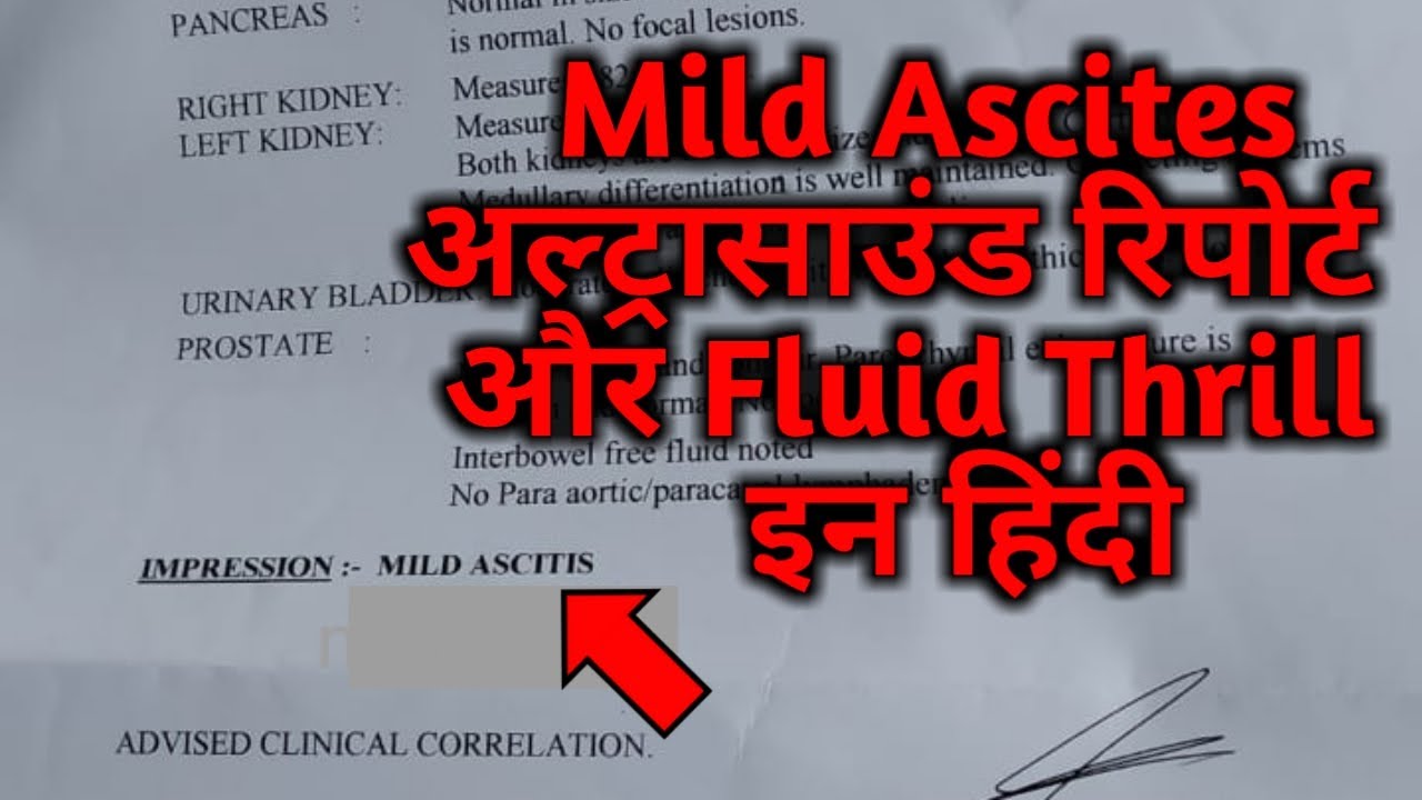 Ascites क्या है, Mild Ascites Ultrasound, Ascites In Hindi, Ascites Reason, Fluids Thrill,Pet m pani