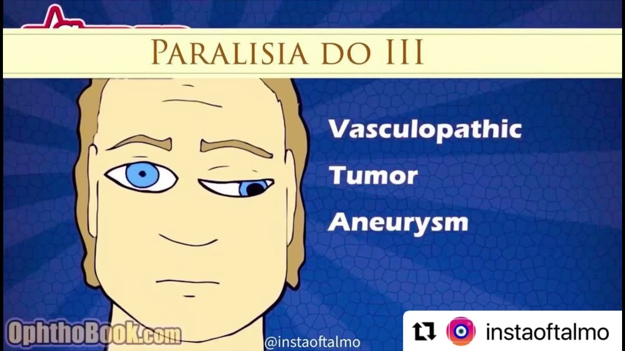 Paralisia do terceiro nervo craniano. Third nerve palsy.