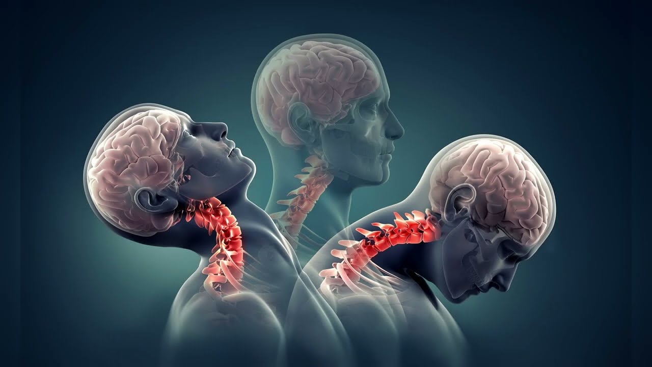 Coup du lapin (whiplash injury) | Pierre-Varnum Hammond