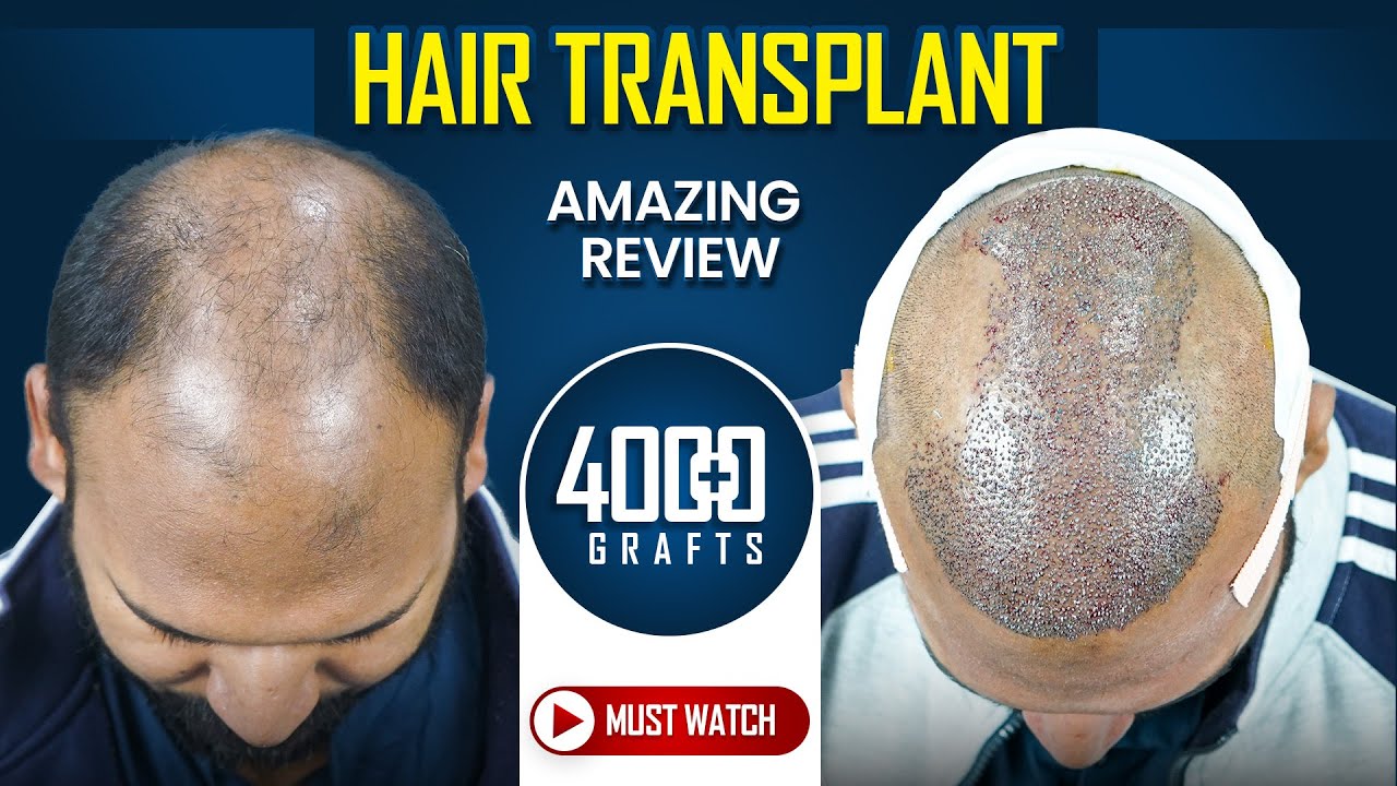 4020 Grafts Hair Transplant in Pune | Amazing Results & Affordable Cost in Pune #hairtransplant