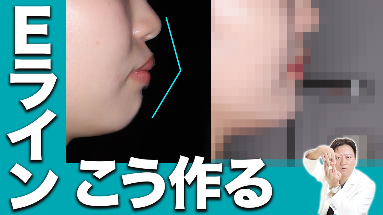 歯列矯正で横顔美人はこう作る！抜歯矯正で口ゴボ・出っ歯を改善し、綺麗なEラインを作るほうほう【審美歯科 ワイヤー矯正 歯並び】