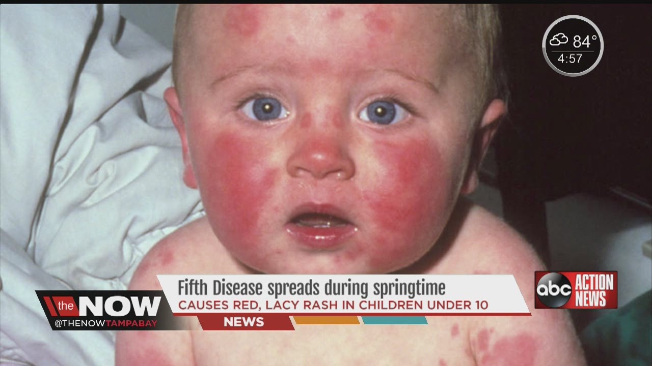Pregnant women need to be aware of a common virus among children during the spring, fifth disease