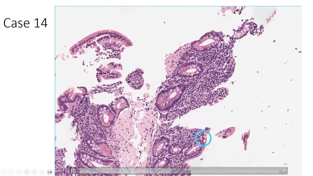 Case (SI 14): Amyloidosis