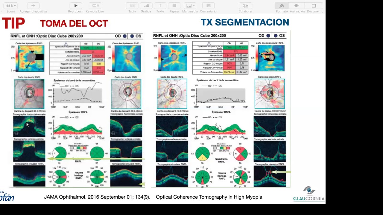 10 Tips en Glaucoma