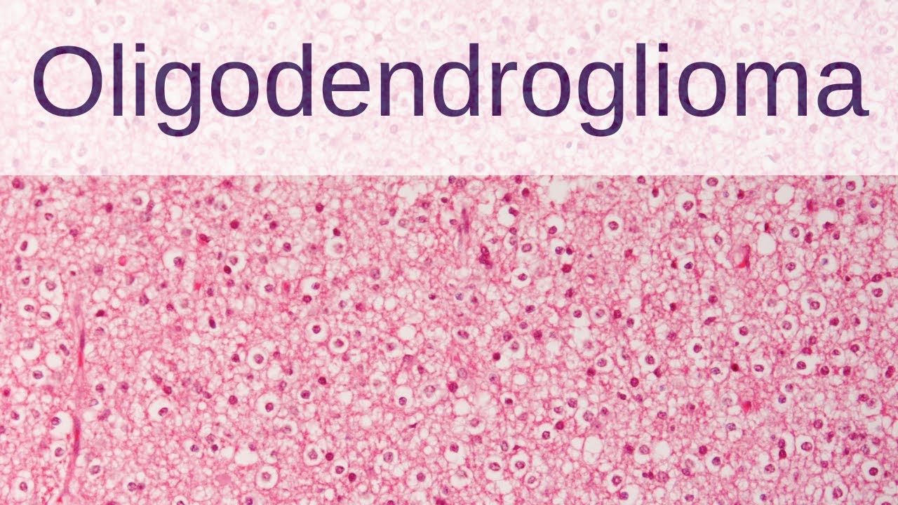 Oligodendroglioma - Pathology mini tutorial