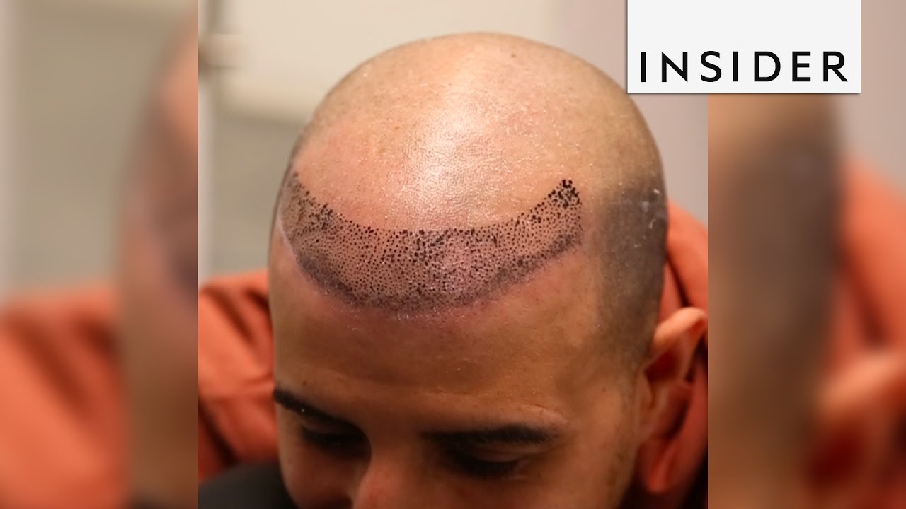 Scalp micropigmentation is a nonsurgical hair loss treatment