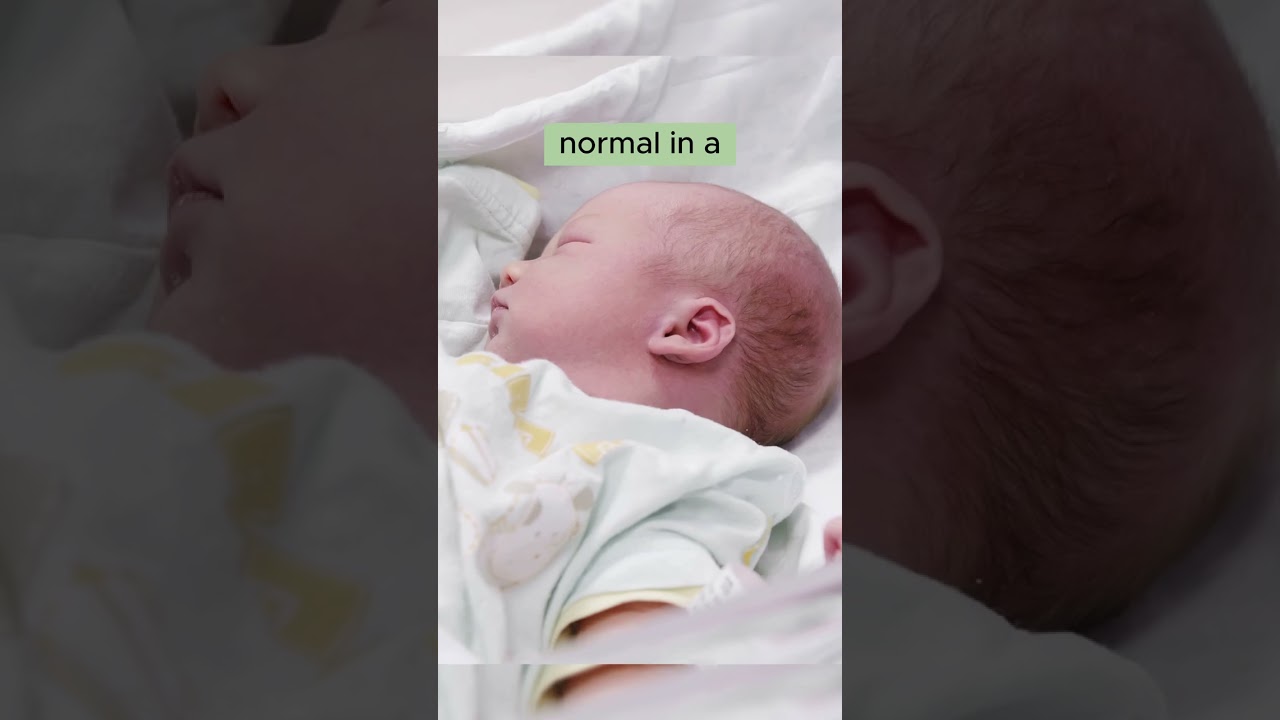 👶🏻Newborn's Head Shape