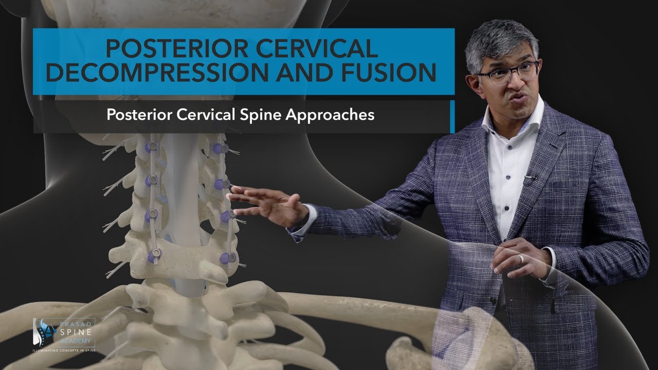 Posterior Cervical Decompression and Fusion