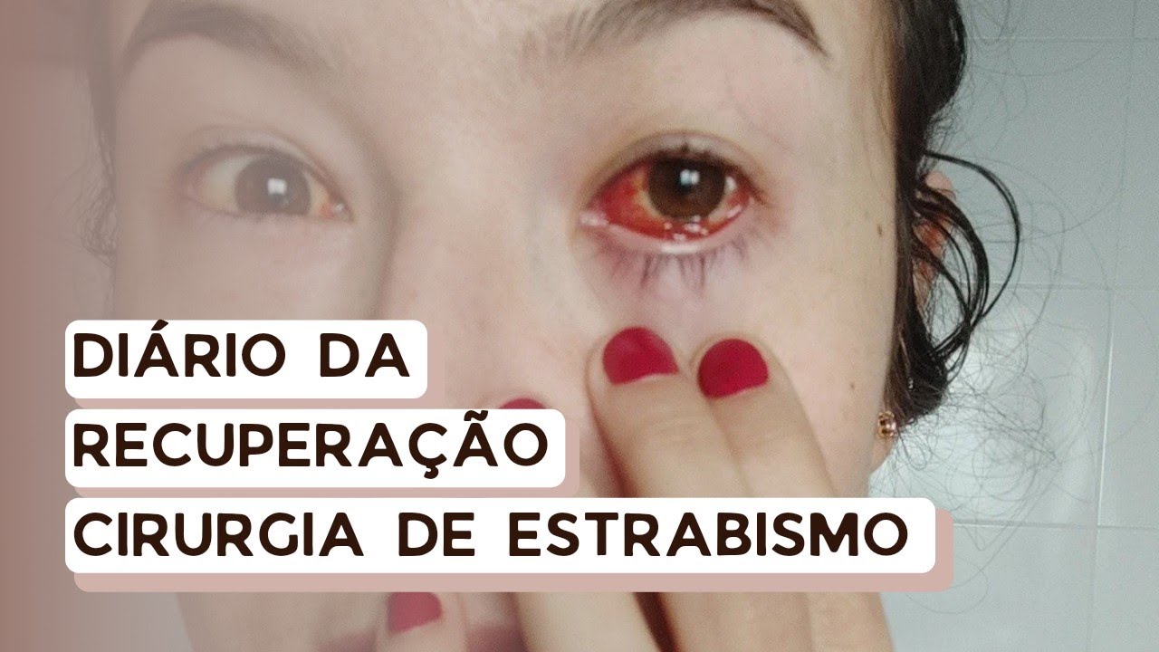 Recuperação cirurgia de estrabismo | Diário |  Ally Arruda
