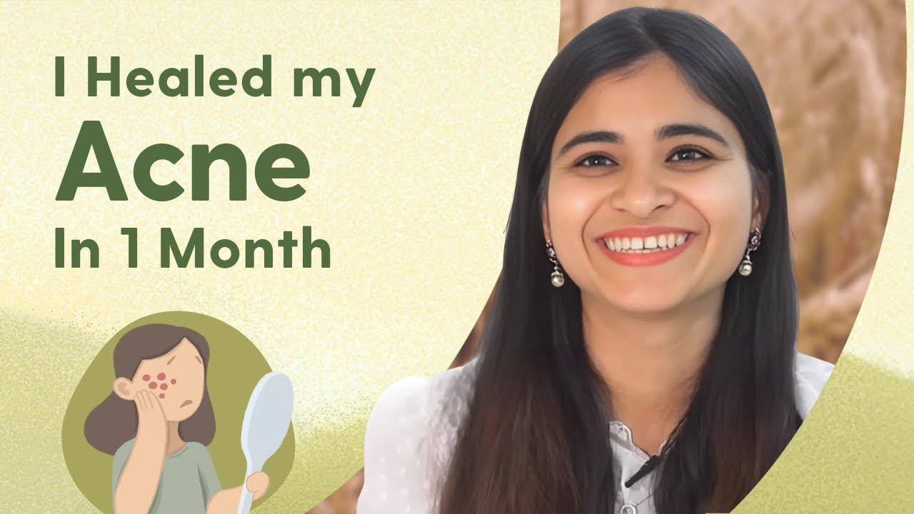 How I Healed My Acne in 1 Month