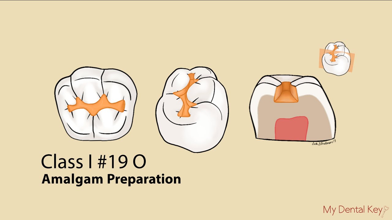 Class I Amalgam Preparation | My Dental Key