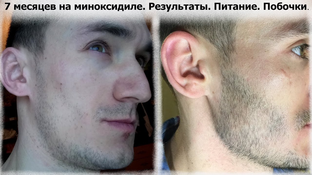 Миноксидил 7 месяцев. Результаты.  Питание.  Побочки.