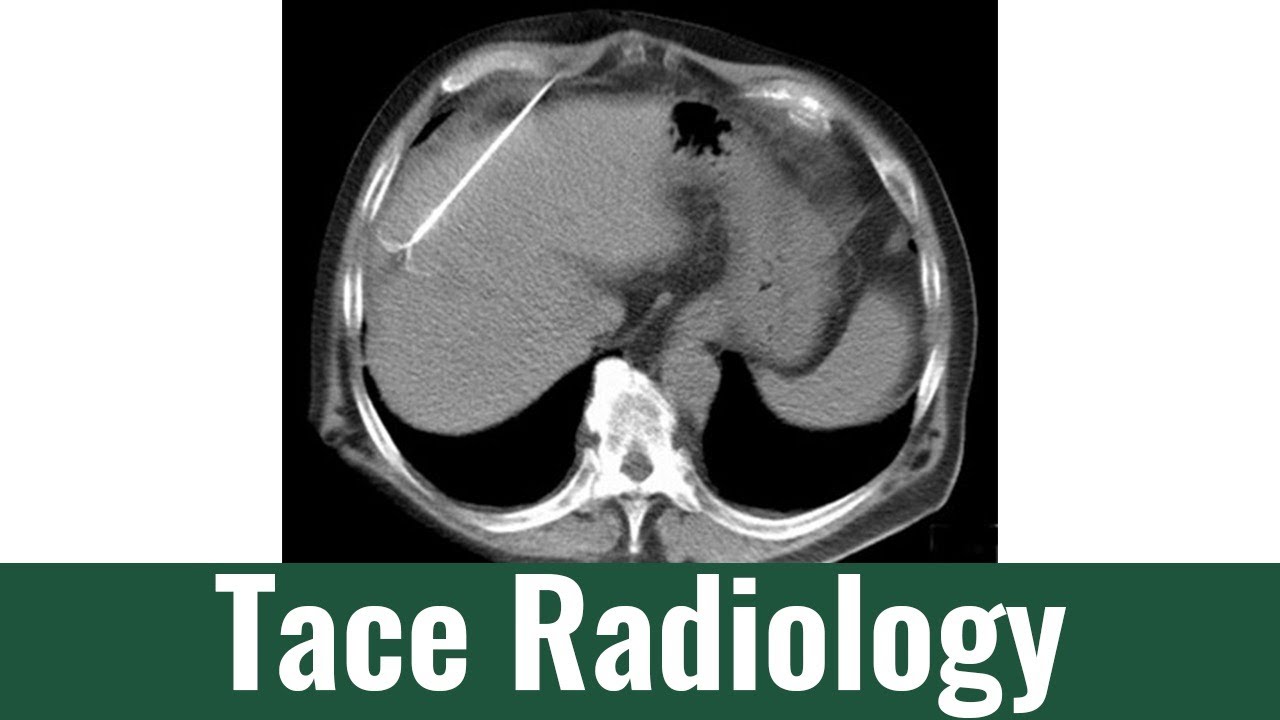 Transarterial Chemoembolization (TACE) Therapy & Procedure: Hepatic Arterial Infusion Chemotherapy