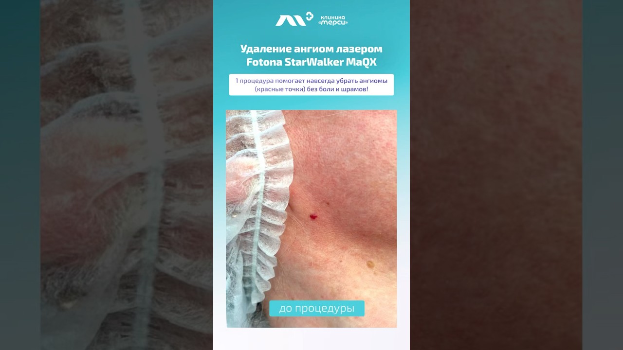 Удаление ангиом лазером Fotona в Клинике &laquo;Мерси&raquo; #гемангиомы #ангиомы #удалениеродинок
