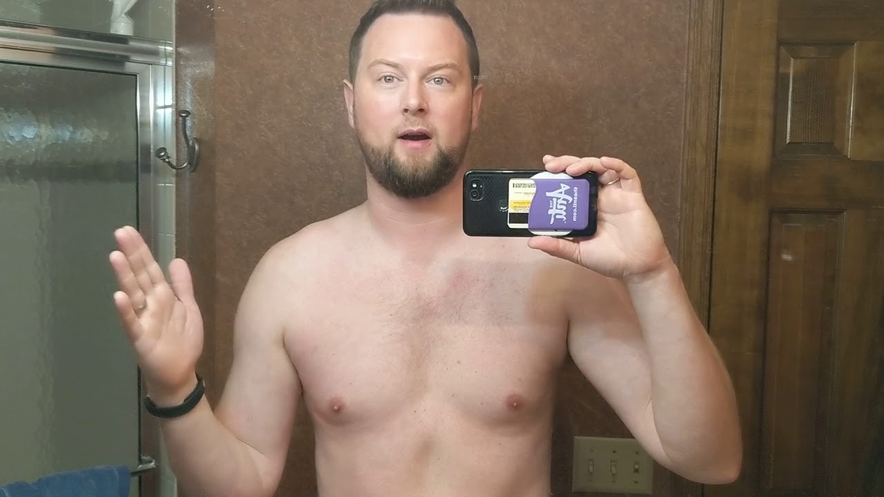 Grade 3 AC Joint Separation 16 Months