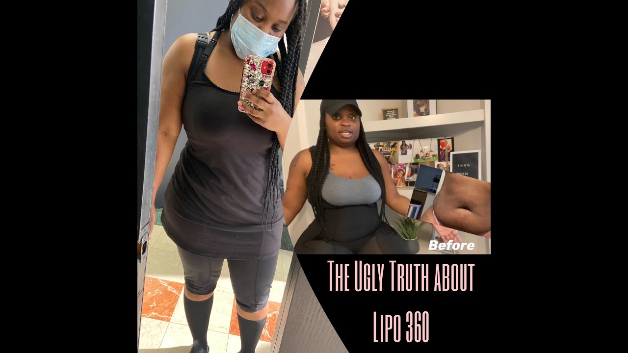 The TRUTH about lipo 360| My lipo 360 Journey in MIAMI|Before & Afters