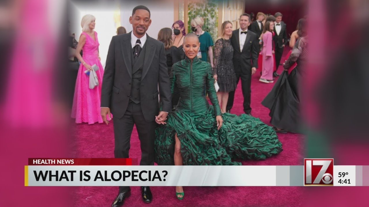 What is Alopecia?