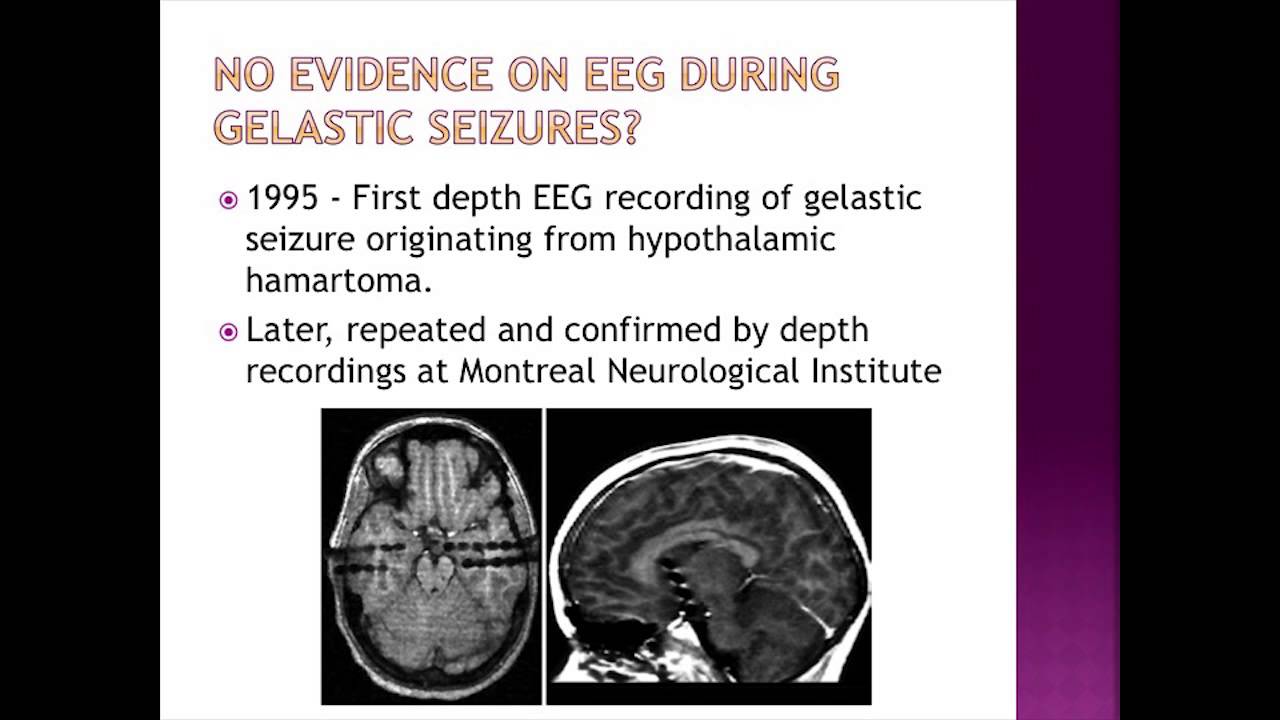 Neurological Assessment (Hypothalamic Hamartomas)- Dr. Michael Quach