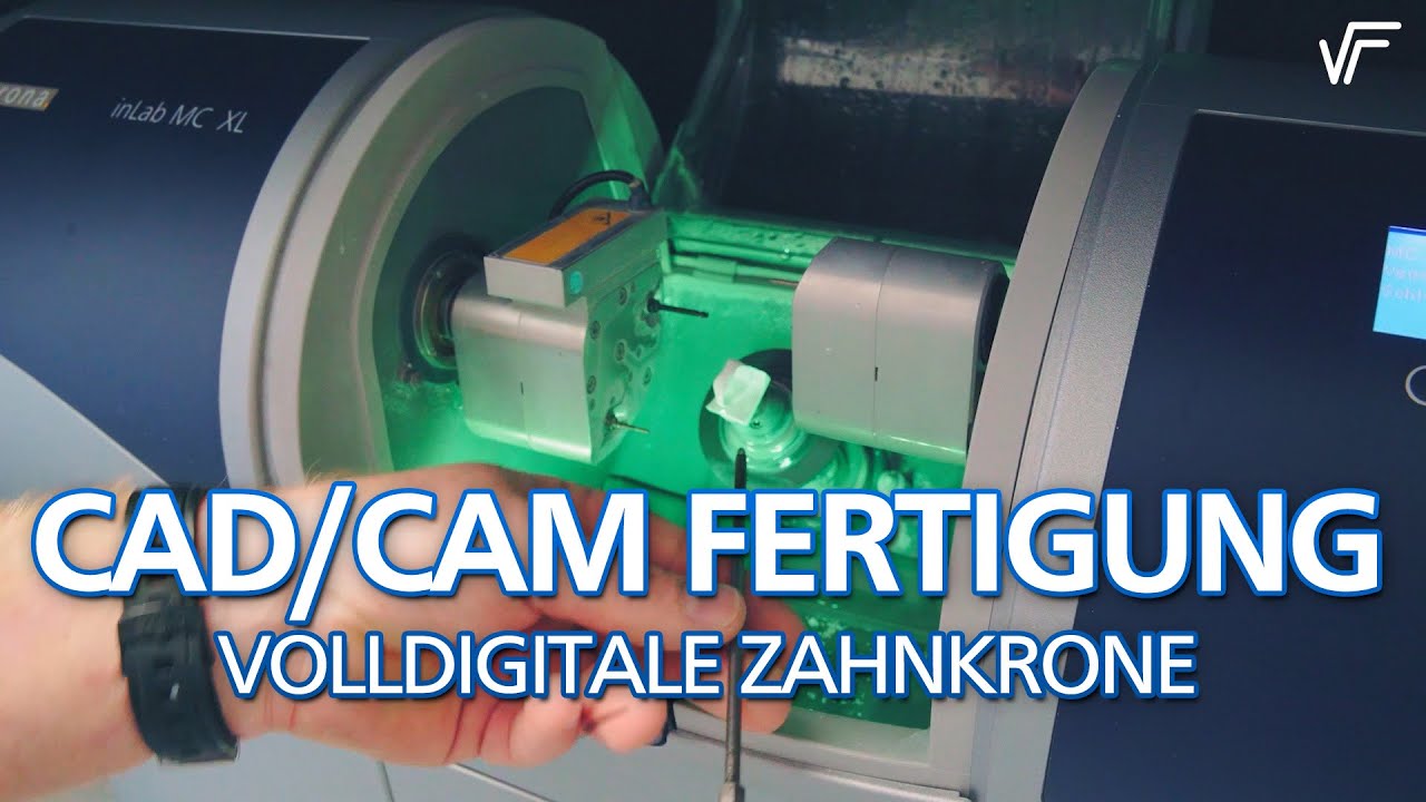 Computergestützte Fertigung von Zahnersatz / Keramikkronen durch CEREC / 3DSHAPE gefertigt