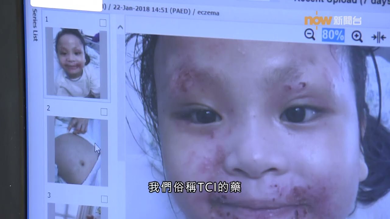 【杏林在線】兒童濕疹護理