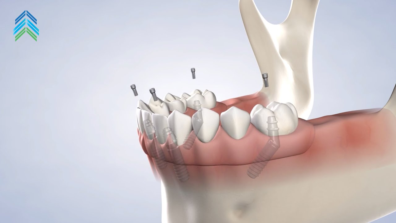Full-Arch Restoration at Avon Oral, Facial and Dental Implant Surgery , Avon, CT