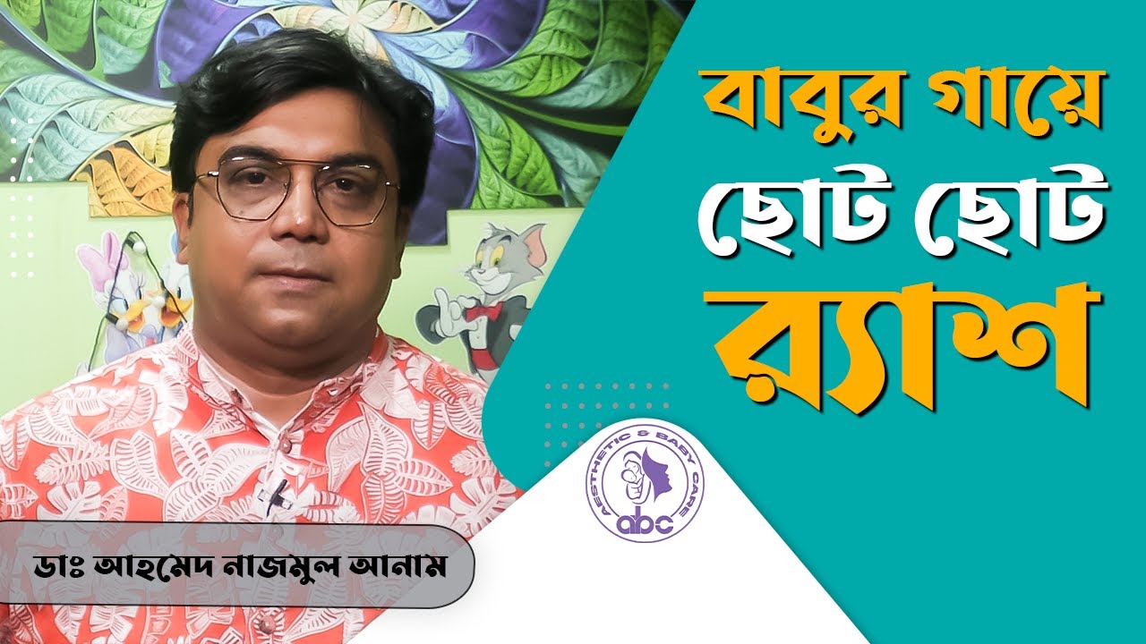 বাবুর গায়ে ছোট ছোট র‌্যাশ ||  ডাঃ আহমেদ নাজমুল আনাম || FCPS, MD- Assistant Professor, ICMH