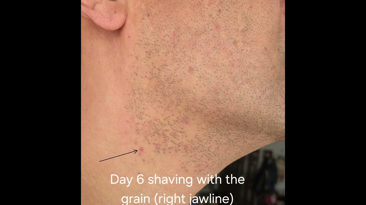 Day 11-17 Test: Razor Bumps gradually improve after shaving with the grain | Dorco PACE 5 PRO