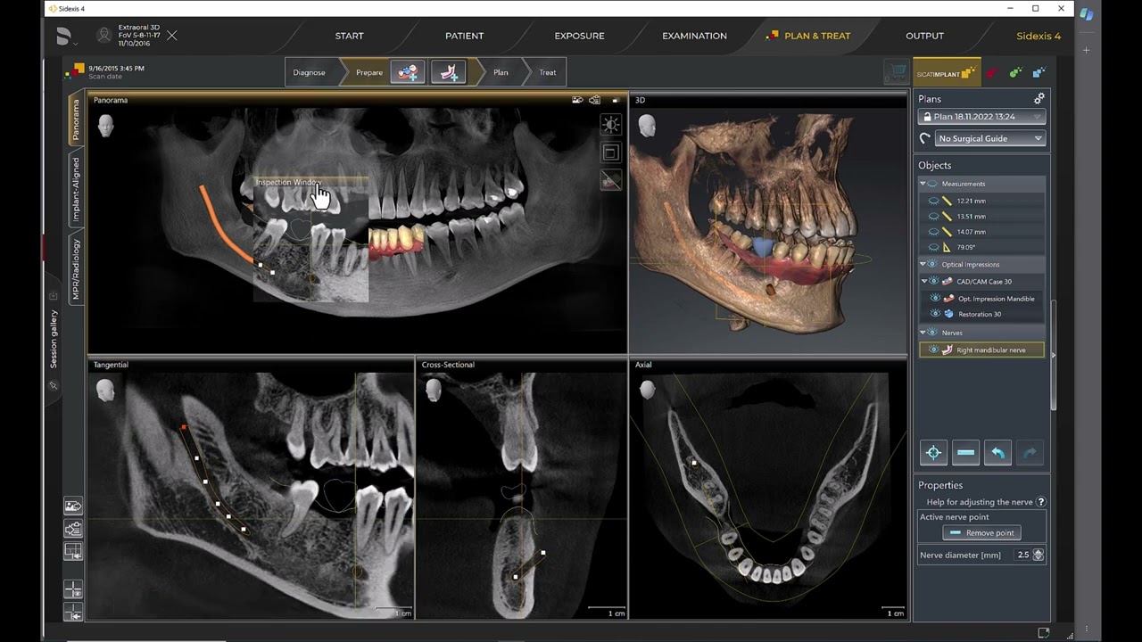 Sicat Implant: Session 4- Marking the Mandibular Nerve
