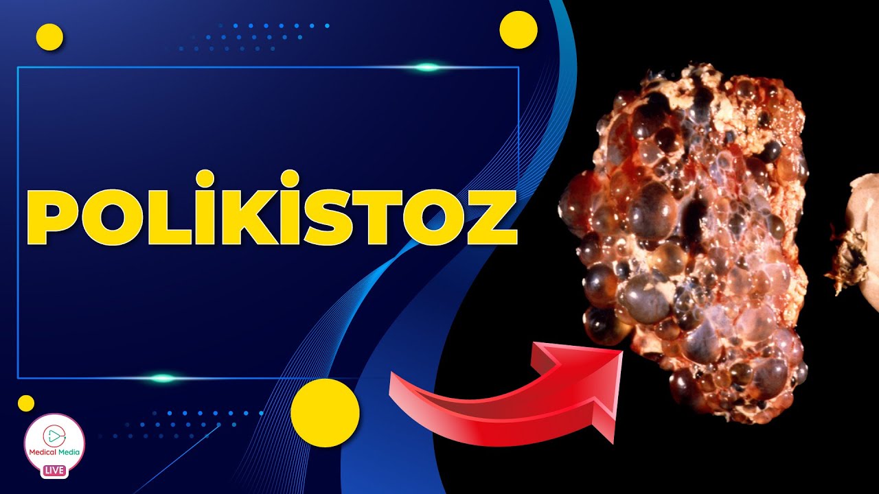 POLİKİSTOZ İLƏ HAMİLƏ QALMAQ MÜMKÜNDÜRMÜ / POLİKİSTOZUN MÜALİCƏSİ NECƏ APARILIR / ENDOKRİNOLOQ