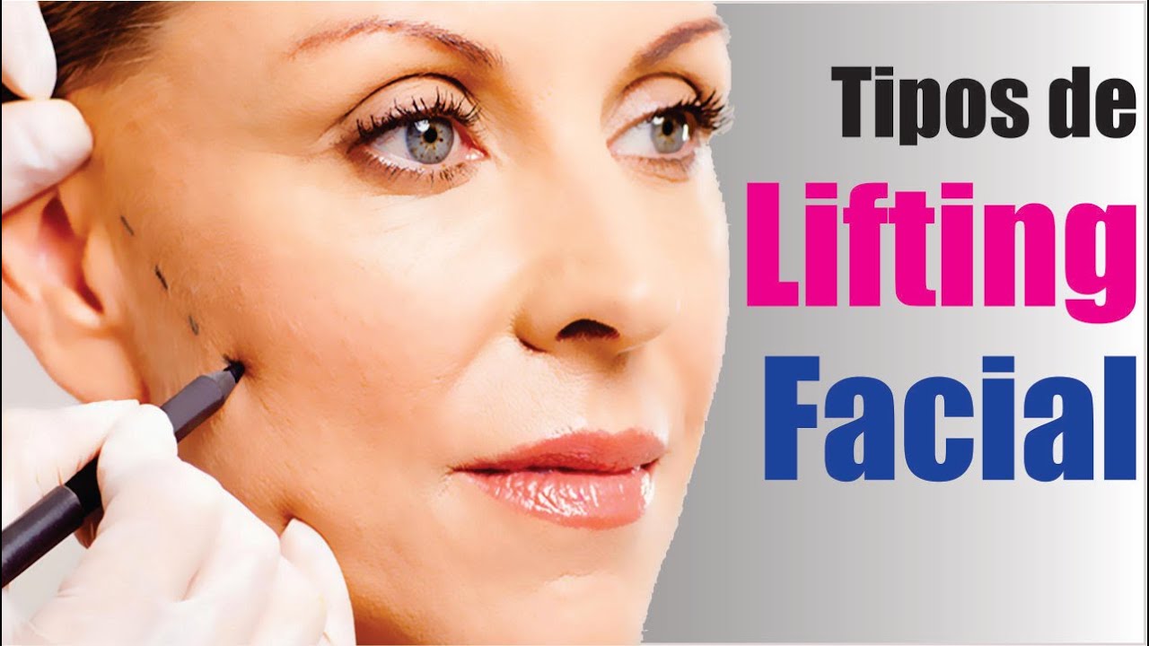 TIPOS de LIFTING FACIAL👩‍🦳➡👩‍🦰 REJUVENECIMIENTO de ROSTRO 🩺 Dr ALBERTO CALVO QUIROZ
