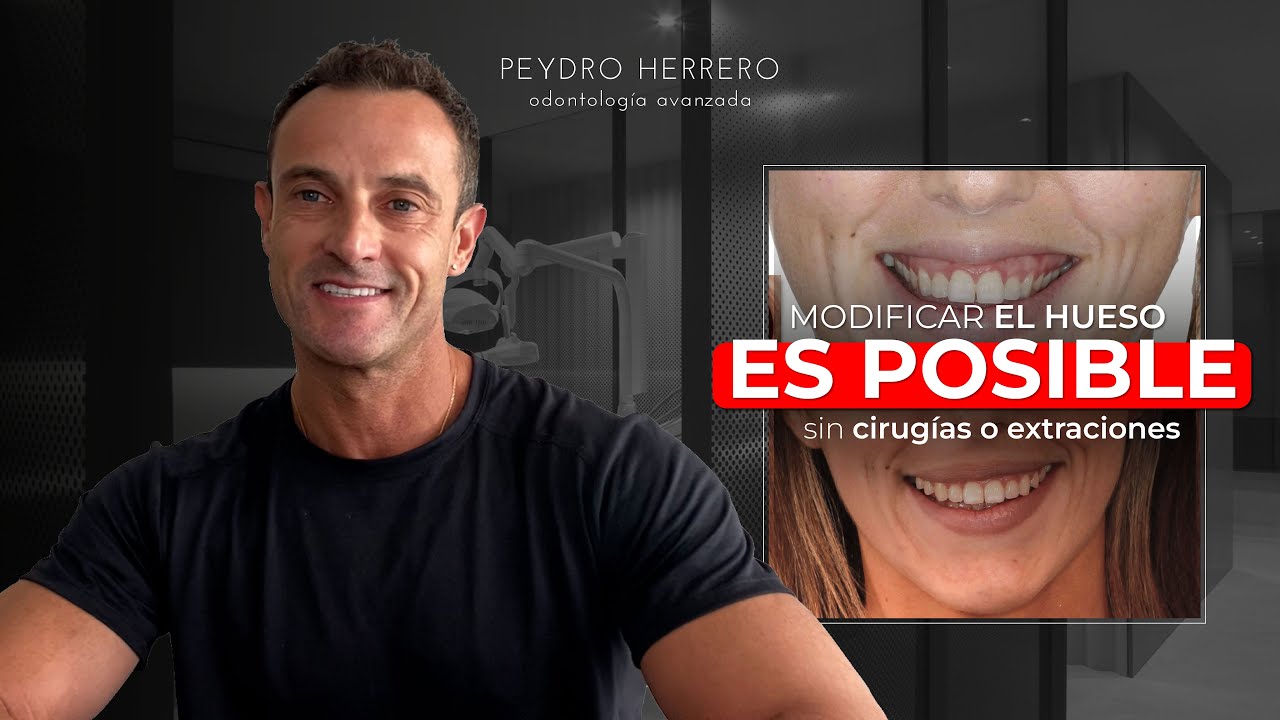 Cómo resolver SIN EXTRACCIONES NI CIRUGÍA una clase II extrema - Clínica Peydro