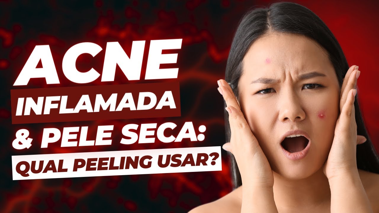 ACNE INFLAMADA E PELE SECA: QUAL PEELING USAR? | Cosmetologia explicada com Prof. Marcio Guidoni