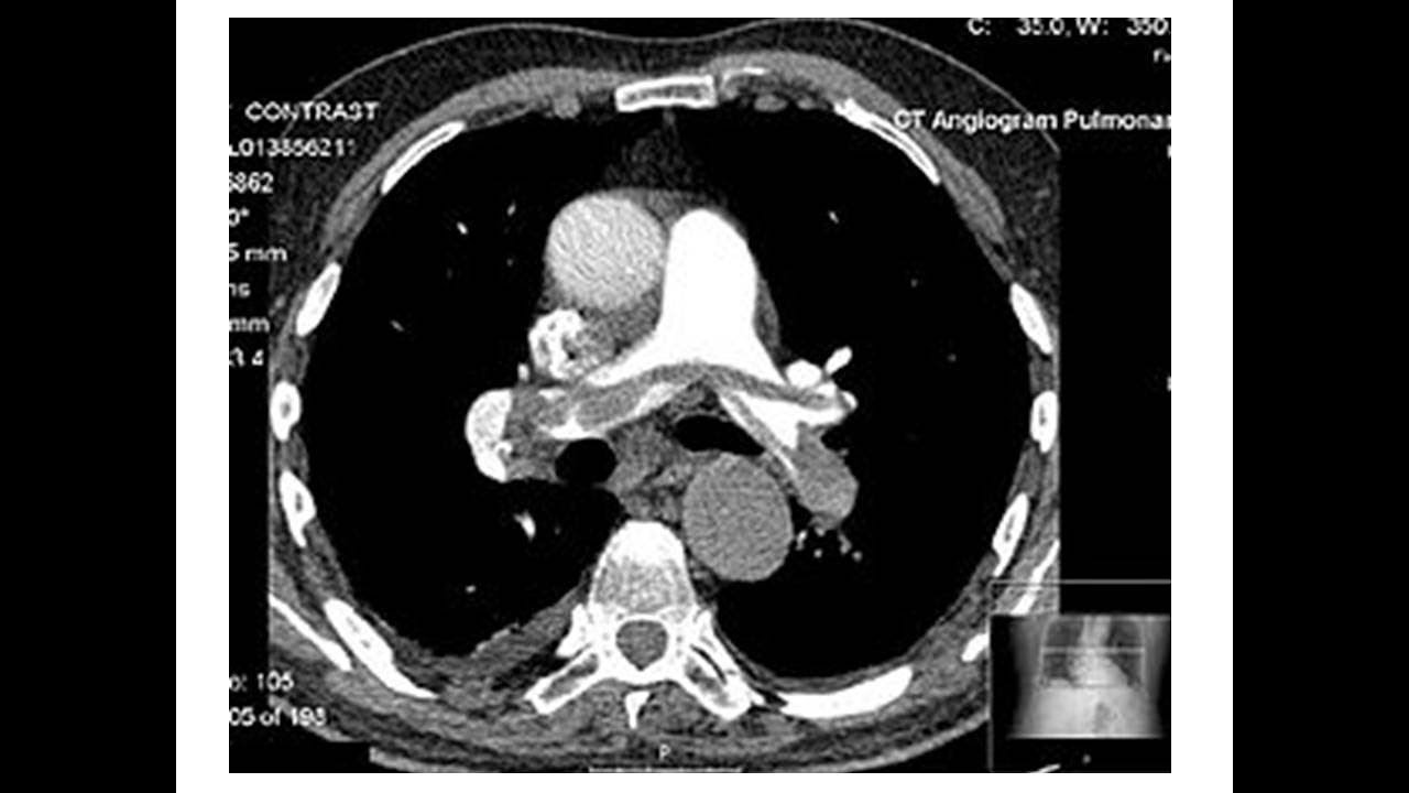 Management of VTE (Dr. Youssef Amin)