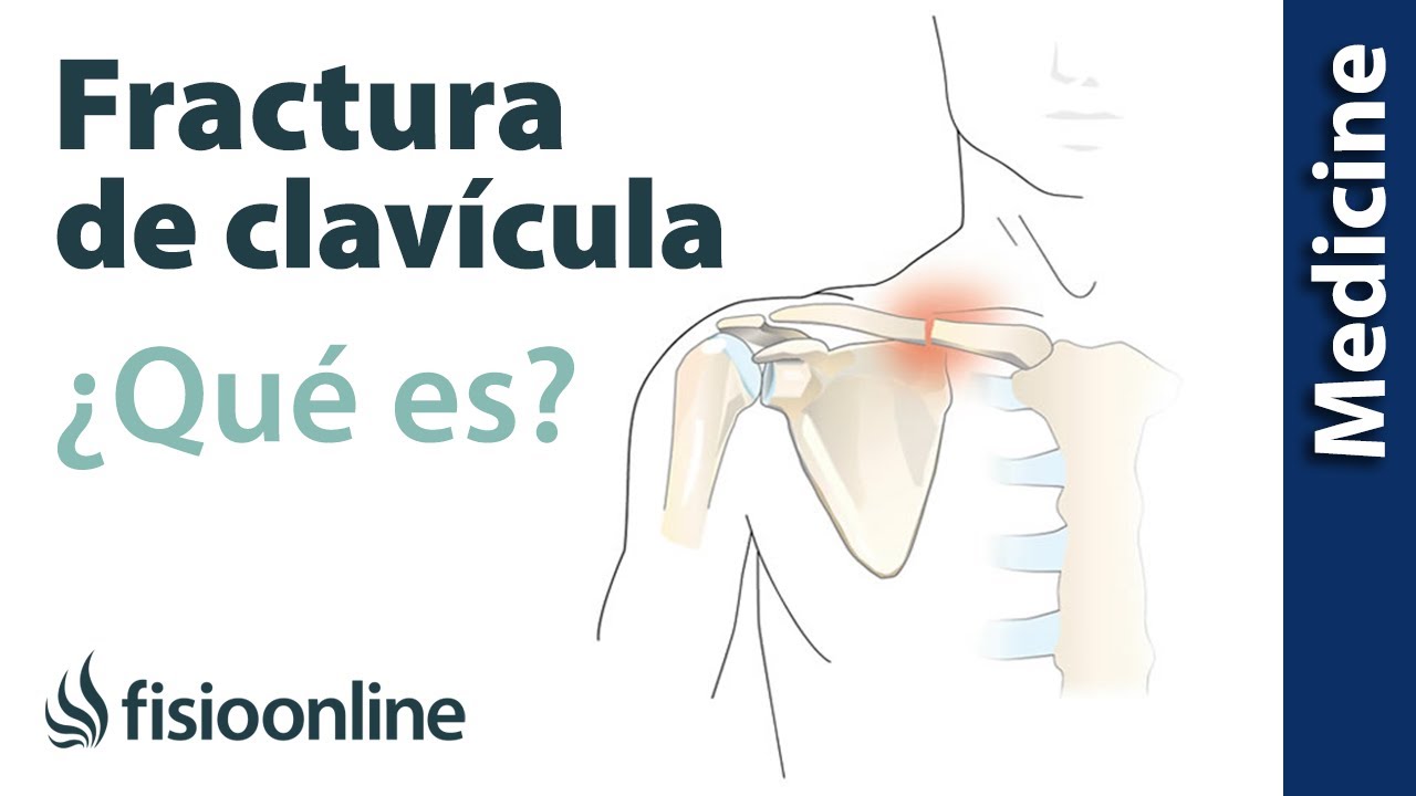 &iquest;Qu&eacute; es la fractura de clav&iacute;cula? Claves para su tratamiento