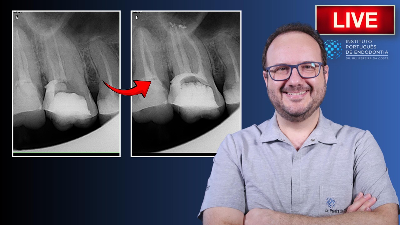 Rtx of 🦷16 with non-locate MB canal | AAP ▶️ Single Session | CASE329