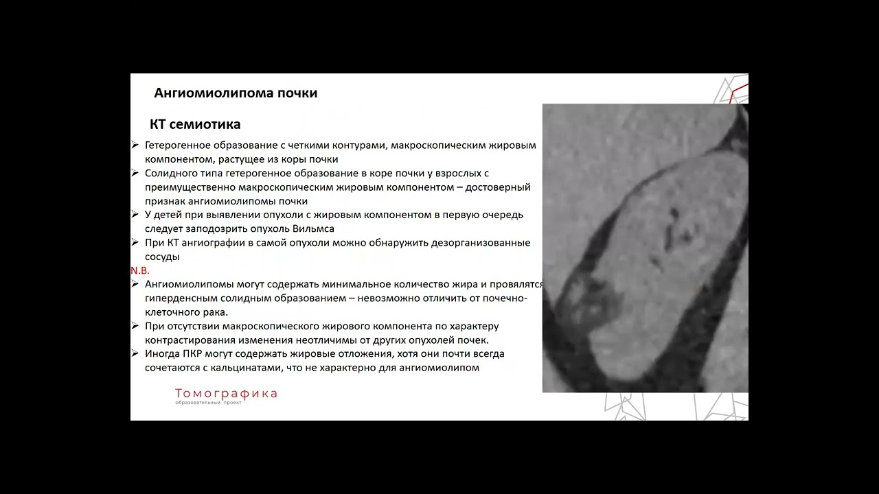 Ангиомиолипома почки