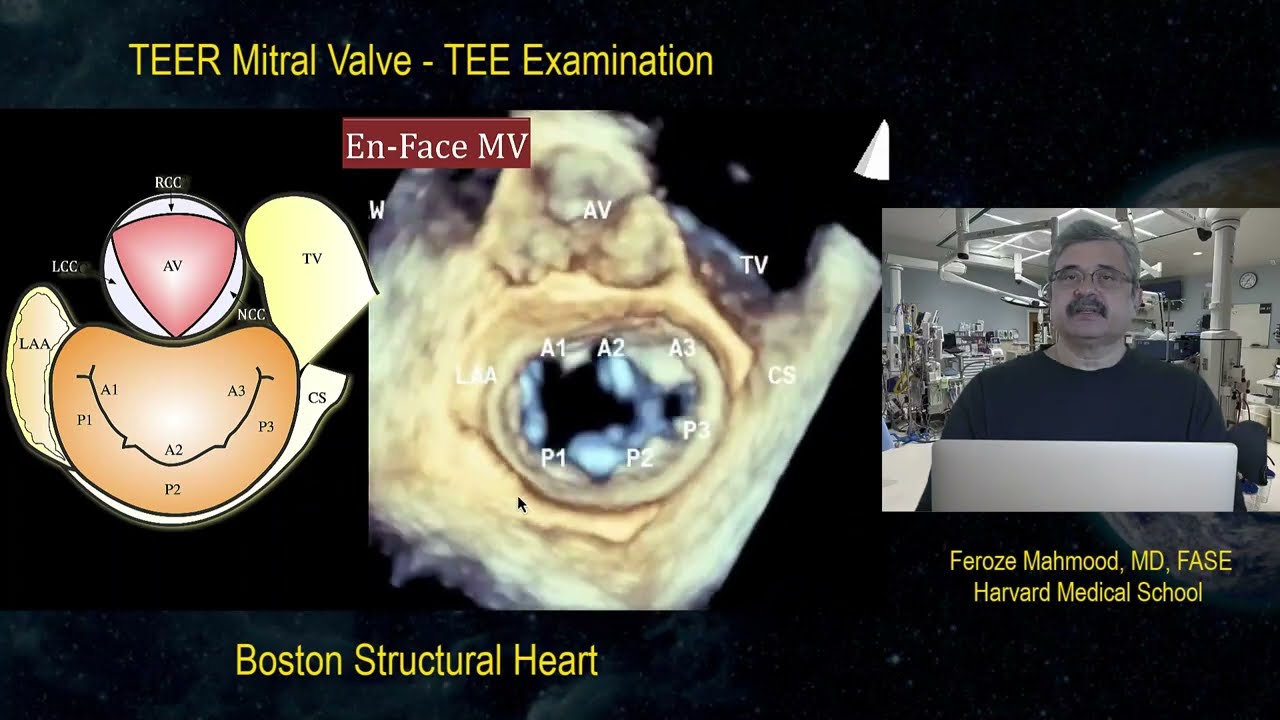 3D Examination of the Mitral Valve
