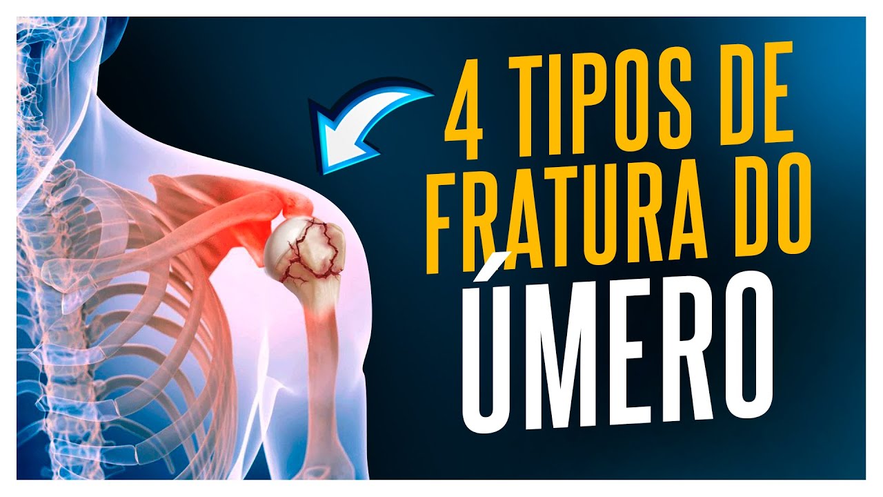 QUATRO PRINCIPAIS FRATURAS QUE VOCÊ PODE SOFRER NO ÚMERO PROXIMAL!