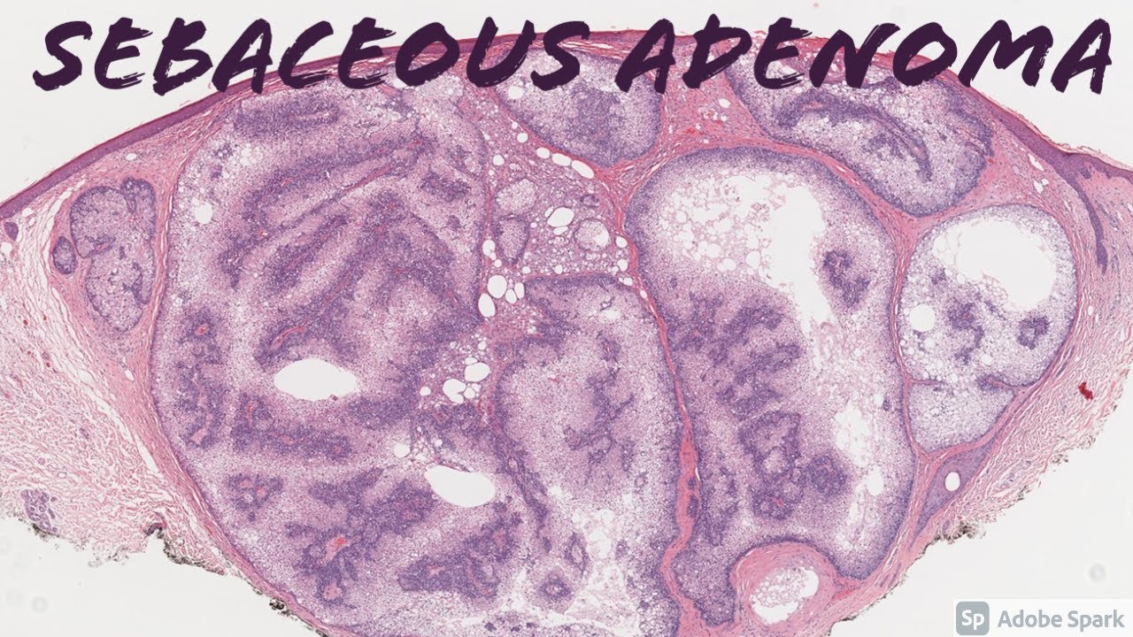 Sebaceous Adenoma: 5-Minute Pathology Pearls