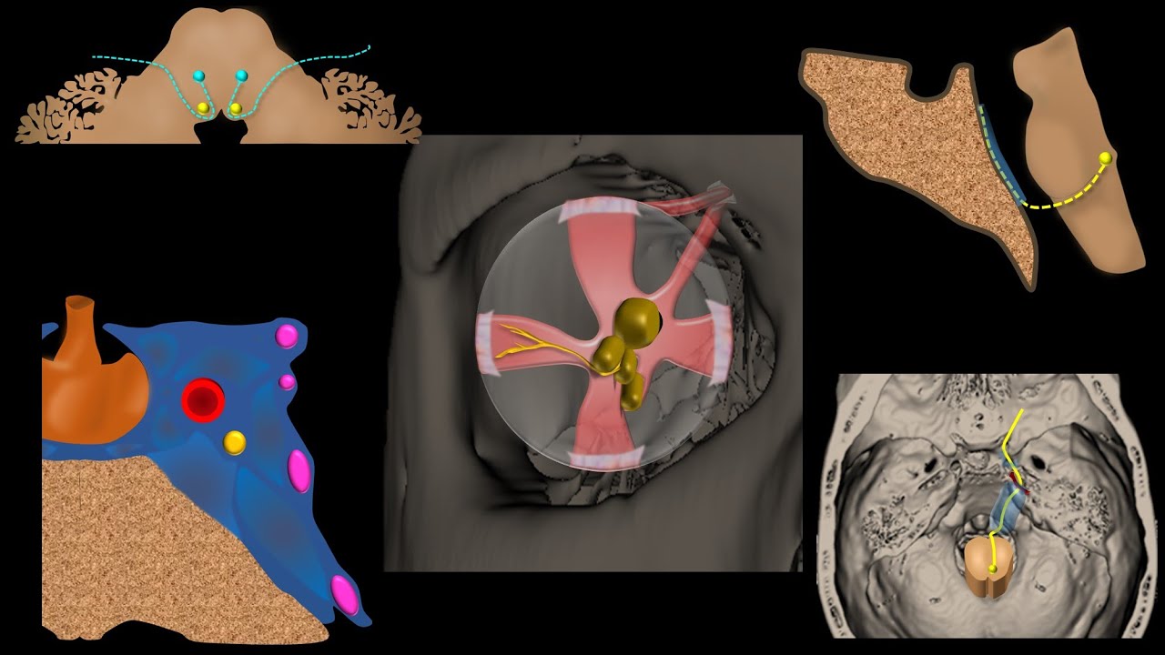 The SIX syndromes of the SIXTH cranial nerve