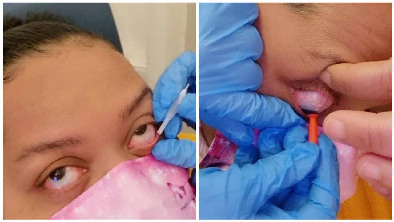 Getting my hard contacts fitting for keratoconus