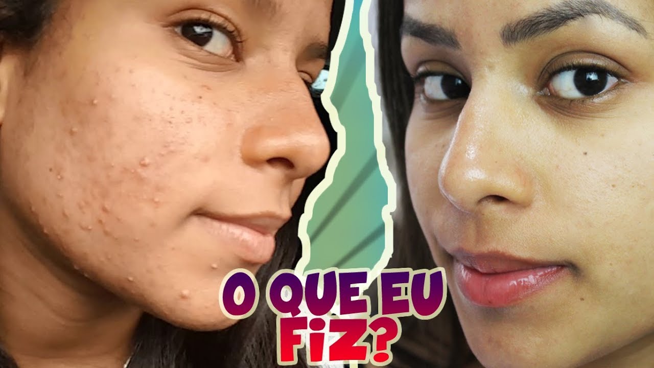 Como ELIMINEI minhas espinhas definitivo [Passo a Passo]