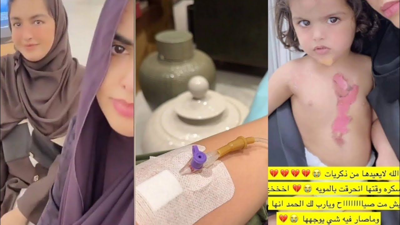 قصة حرق جسم بنتها سكرة 😳😢 تخلص اخر تجهيزات الزواج مع مرضها 🔥ديمة عشق الطفولة😍سارة الودعاني