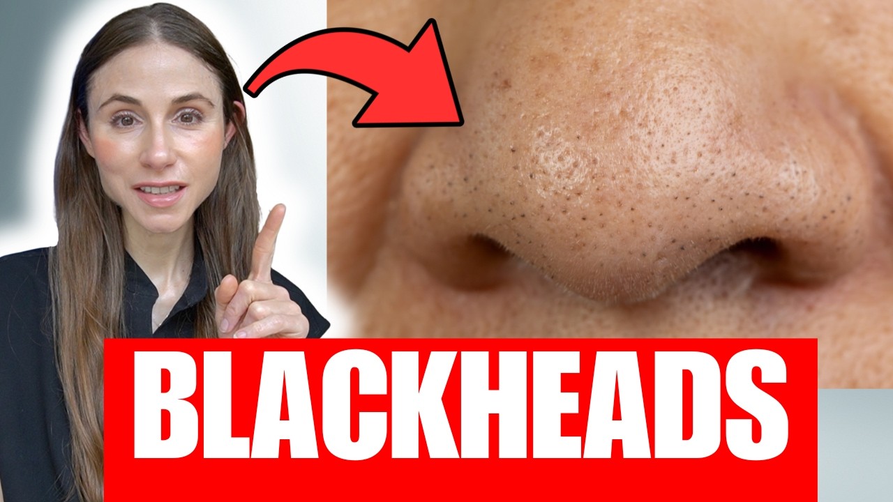 Blackheads on the Nose? Here&rsquo;s What They Really Are | Derm Explains