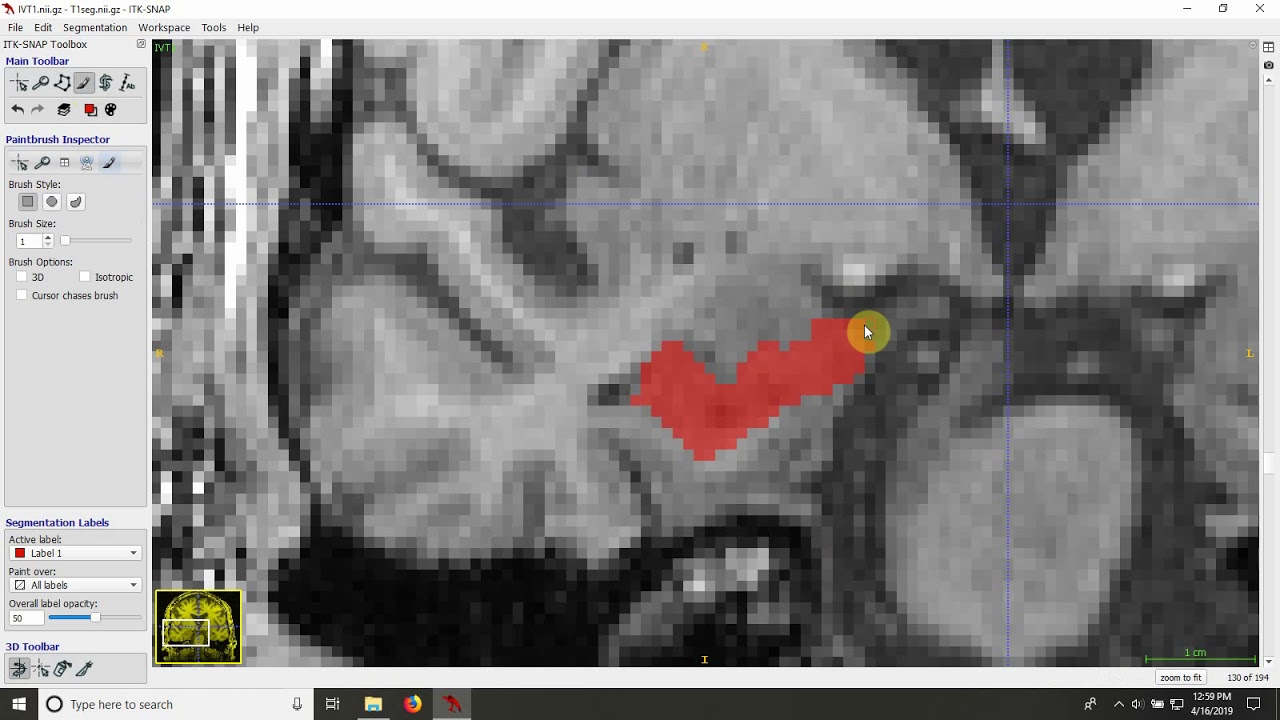 Demonstration of whole hippocampus segmentation on T1-weighted MRI