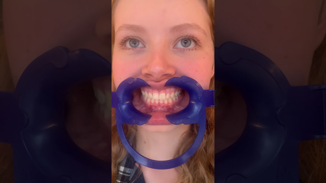 Dr. Smith- How to use your cheek retractors during a virtual appointment